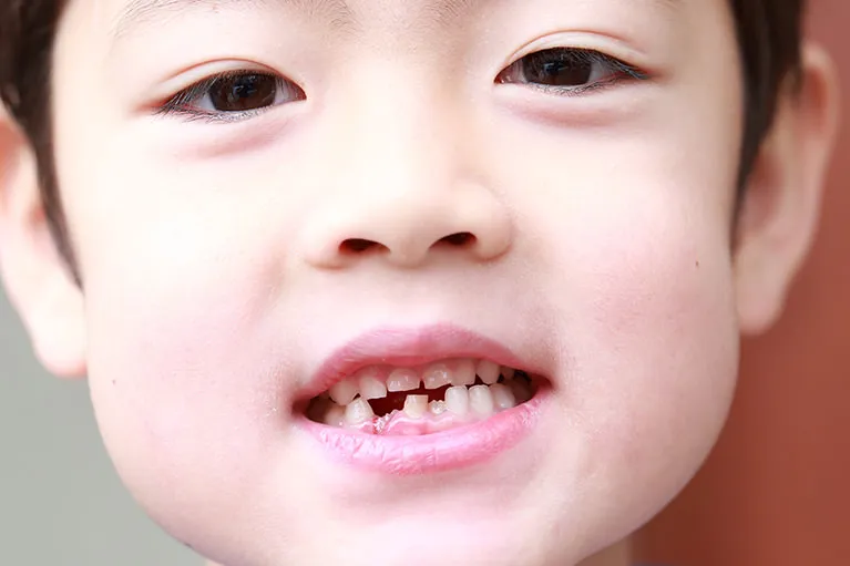 むし歯の多い方への食事指導